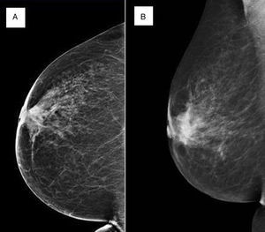 Imagen de la mamografía de cribado (A) y de la mamografía diagnóstica (B) realizadas a la paciente.