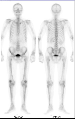 Gammagrafía ósea, en la que se identifica acúmulo de radiotrazador de moderada intensidad en rótulas y periostio de la diáfisis de los fémures, las tibias y los húmeros.