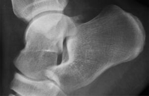 Radiografía del tobillo derecho. Proceso de Stieda: tubérculo lateral de la apófisis posterior del astrágalo prominente.