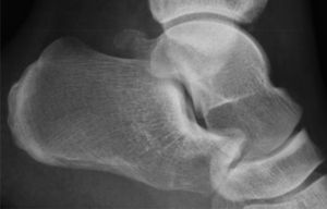 Radiografía del tobillo izquierdo. Proceso de Stieda asociado a os trigonum no fusionado, o fracturado de la apófisis posterior.