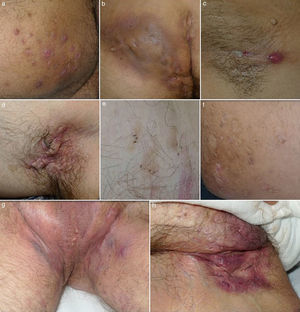 Imágenes clínicas de la hidrosadenitis supurativa. a) Nódulos inflamatorios localizados en la cara interna del muslo derecho. b) Gran absceso y fístula crónica que ocupa la nalga derecha. Destaca la hiperpigmentación de la nalga afecta. c) Fístula lineal en fase inicial. Se aprecia un nódulo inflamatorio y un sinus drenante localizado en la axila de una mujer de 22 años. d) Cicatriz en puente en axila izquierda. e) Dobles y triples comedones. f) Cicatrices atróficas tipo «boxcar». g) Hidrosadenitis de predominio folicular con presencia en el área inguinogenital de numerosos quistes, nódulos inflamatorios y abscesos. Llama la atención el eritema y edema que envuelve toda el área afecta. h) Cicatrices y fístulas drenantes en ingle derecha.