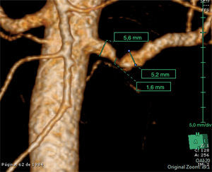 Angiografía tomográfica computarizada de la aorta abdominal del paciente. Se observa una estenosis de la arteria renal izquierda próxima a su origen superior al 80%. Fuente: Servicio de Radiología del hospital de referencia.