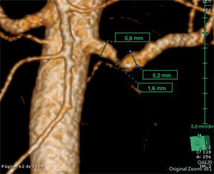 Angiografía tomográfica computarizada de la aorta abdominal del paciente. Se observa una estenosis de la arteria renal izquierda próxima a su origen superior al 80%. Fuente: Servicio de Radiología del hospital de referencia.