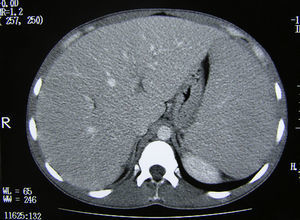 Imagen TAC abdominal: se objetiva una muy importante hepatoesplenomegalia sin lesiones ocupantes de espacio.