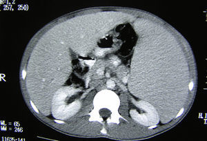Imagen TAC abdominal a nivel renal: se objetiva hepatoesplenomegalia y múltiples adenopatías retroperitoneales.