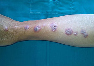 Varias pápulas eritemato-violáceas en el sitio de inoculación (chancro de inoculación), de consistencia nodular y gomosa, y con tendencia a la cicatrización. Se puede observar como las lesiones siguen el trayecto de los vasos linfáticos.