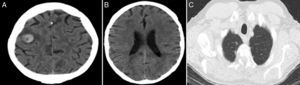 A) Imagen compatible con neoplasia cerebral primaria. B) Ausencia de otras lesiones cerebrales asociadas. C) Nódulos pulmonares bilaterales de pequeño tamaño, dados como probables metástasis de origen desconocido.