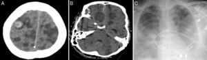 A y B) Múltiples lesiones cerebrales diseminadas. C) Afectación pulmonar intersticio-alveolar bilateral.