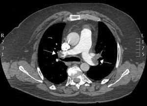 Defectos de replección compatibles con tromboembolismo de arterias pulmonares (flechas).