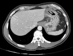 Corte axial de tomografía computarizada abdominal que muestra una fina lámina de líquido perihepático (flechas blancas) y un engrosamiento muy marcado de los pliegues gástricos (flechas negras).