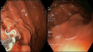 Visualización endoscópica de parásitos en la mucosa gástrica y extracción con pinza de conglomerados vivos.
