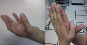 Exploración física de la paciente. En la parte izquierda de la imagen, se observa cómo la paciente es capaz de opositar y lateralizar el primer dedo («cuenta dedos») en la mano izquierda (la afectada). Sin embargo, en la parte derecha de la imagen, comparando con la mano sana (la derecha), se observa cómo la paciente es incapaz de realizar la extensión del primer dedo afectado (izquierdo) mientras mantiene en extensión el primer dedo sano (derecho).