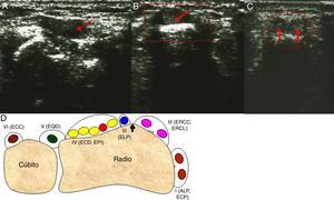 A) Imagen ecográfica del primer compartimento de la cara dorsal de la muñeca de la mano izquierda (la afectada) de la paciente. Se observa corte longitudinal a nivel de la tabaquera anatómica donde se visualiza zona anecoica (señalizada mediante flecha) a nivel de la vaina tendinosa del extensor corto del primer dedo, que indica que falta el mismo. B) Imagen ecográfica del primer compartimento de la cara dorsal de la muñeca de la mano izquierda (la afectada) de la paciente. Se observa corte transversal a nivel de la tabaquera anatómica, donde se localiza el primer compartimento de la cara dorsal de la muñeca. Se visualiza un único tendón que corresponde al abductor largo del primer dedo (rodeado mediante círculo y señalizado mediante flecha); el extensor corto del primer dedo (más posterior) no se visualiza. C) Imagen ecográfica del primer compartimento de la cara dorsal de la muñeca de la mano derecha (no afectada) de la paciente. Se observa corte transversal a nivel de la tabaquera anatómica, donde se localiza el primer compartimento de la cara dorsal de la muñeca. Se visualizan 2 tendones que corresponden al tendón del abductor largo del primer dedo y del extensor corto del primer dedo (rodeados mediante círculo y señalizados mediante flechas). D) Esquema de la exploración ecográfica de la cara dorsal de la muñeca. Se indican los 6 compartimentos y sus correspondientes tendones (ALP: abductor largo del primer dedo; ECC: extensor cubital del carpo; ECD: extensor común de los dedos, del segundo al cuarto; ECP: extensor corto del primer dedo; ELP: extensor largo del primer dedo; EPI: extensor propio del índice; EQD: extensor del quinto dedo; ERCC: extensor radial del carpo corto; ERCL: extensor radial del carpo largo). La flecha señala el tubérculo de Lister, relieve óseo a nivel radial que sirve como referencia ecográfica por su fácil identificación, y separa el segundo y el tercer compartimento.