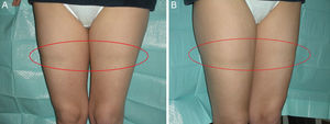 A y B) Lipoatrofia semicircular.