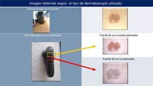 Visualización con dermatoscopios de inmersión y con dermatoscopios de luz polarizada.