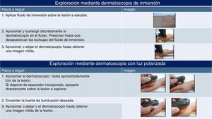 Técnica de exploración con dermatoscopio de inmersión y con dermatoscopio de luz polarizada.