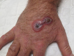 Lesión en estadio dianiforme en la primera visita del paciente, consistente en 2 placas violáceas unidas con halo eritematoso y centro ampolloso.