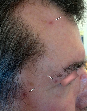Lesiones vesiculosas en zona hemifacial derecha.