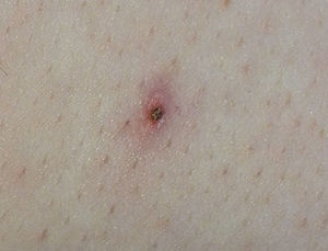 Lesión con zona central costrosa de 2mm y halo periférico eritematoso en hemitórax derecho.