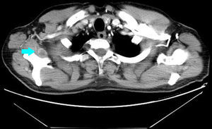 TAC torácica que evidencia un nódulo en el subescapular derecho.