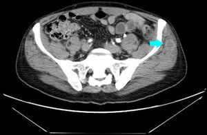 TAC abdominal que evidencia nódulos en el glúteo.