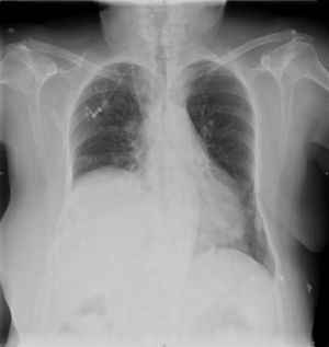 Radiografía de tórax con elevación del hemidiafragma derecho.