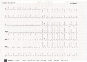 Taquicardia paroxística supraventricular a 180 latidos por minuto.