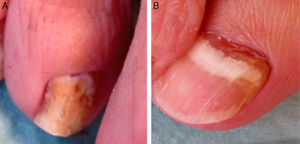 A) OM blanca superficial en tercer dedo del pie derecho. B) OM subungueal proximal en primer dedo del pie derecho.