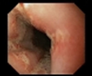 «Kissing ulcers» a varios niveles.