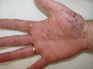 Pustulosis palmoplantar: muestra las lesiones dermatológicas típicas del síndrome SAPHO en zona volar de la mano derecha.