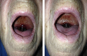Edematización de la úvula con hematoma generalizado con zonas aisladas de necrosis.
