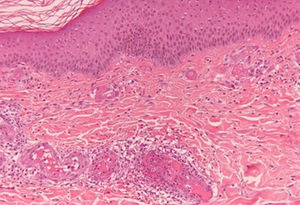 Necrosis fibrinoide con afectación de las arteriolas de la dermis, con extravasación de hematíes.
