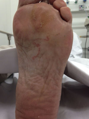 Imagen serpinginosa en la planta del pie izquierdo, edematosa y eritematosa, entre 1-3cm de longitud y entre 1-2mm de espesor.