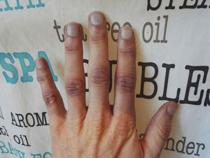 Fenómeno de Raynaud en ambas manos no relacionado con la exposición al frío ni con alteraciones emocionales.