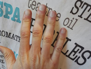 Cesión espontánea del fenómeno de Raynaud al cabo de 30-50min.