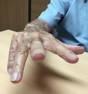 Limitación espontánea de la extensión activa de meñique y anular de la mano derecha.
