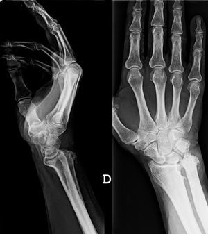 Artropatía degenerativa evolucionada con marcada desestructuración articular radio-cubital distal, con alargamiento y elevación del cúbito respecto al radio (cúbito plus) y desviación dorsal de la cabeza cubital.