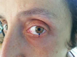 Nódulo de Lisch: hamartomas melanocitarios de naturaleza idéntica a las manchas café con leche, ubicados en el iris. No comprometen el campo visual. Son visibles como nódulos marrones si se observan con lámpara de hendidura.
