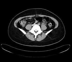 Tomografía axial computarizada que muestra vena ilíaca común izquierda comprimida entre la arteria común ilíaca derecha y la parte anterior del cuerpo vertebral.