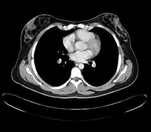 Tomografía axial computarizada que muestra la trombosis de las arterias pulmonares con defectos de llenado de localización central y con paso periférico del contraste (signo del anillo).