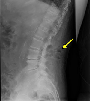 Radiografía simple de columna vertebral lumbar (proyección lateral). Presencia de densidad aire en las partes blandas de la región posterior, a la altura de L2-L3, sugestivo de enfermedad infecciosa.