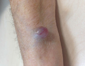 Nódulo violáceo en antebrazo izquierdo.