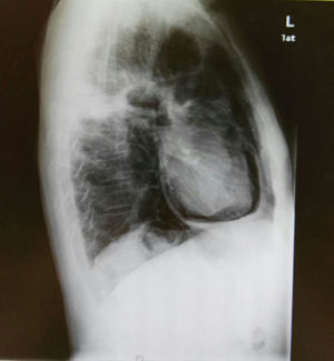 Aumento de densidad en el lóbulo superior izquierdo cavitada (compatible con masa pulmonar ya conocida). Silueta cardiaca normal, mostrando en proyección lateral una imagen aérea que delimita el pericardio, compatible con neumopericardio.