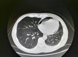 Reducción global de volumen en el hemitórax izquierdo; se aprecia masa parahiliar izquierda en relación con neoplasia conocida, que se encuentra cavitada, cavitación presente en TAC previa de 2 meses antes, y que presenta un trayecto fistuloso que se dirige al bronquio principal izquierdo, siendo posible que exista comunicación con el bronquio. Se visualiza un segundo trayecto fistuloso que se dirige inferiormente y comunica con el pericardio, originando neumopericardio.