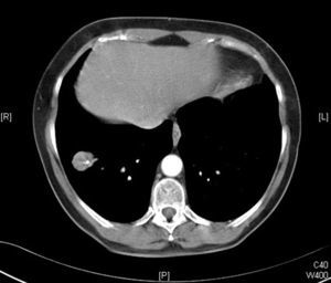 TAC helicoidal con contraste, que objetiva la lesión como un nódulo de bordes bien definidos, de 26×21mm, con 2 calcificaciones puntiformes localizadas excéntricamente.