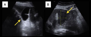 A) Vesícula biliar. B) Absceso hepático.