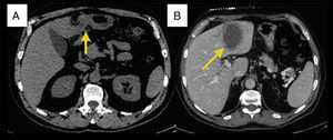 A) Engrosamiento duodenal. B) Absceso hepático.