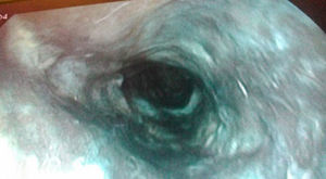 Imagen endoscópica de esófago proximal y distal donde se observa mucosa con un tono parduzco con exudados algodonosos tapizando toda la circunferencia esofágica.