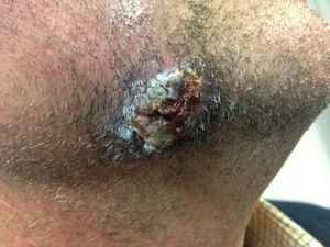 Lesión eritematoedematosa rápidamente progresiva, exudativa y dolorosa que posteriormente se volvió negruzca.