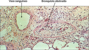 Bronquiolitis obliterante. Biopsia transbronquial de un paciente trasplantado que muestra un bronquiolo con su luz completamente obstruida.